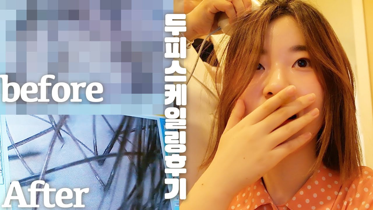 두피 각질 센터에서 두피 스케일링 받은 후기 💆 Scalp scaling review⎪우주쏘녀