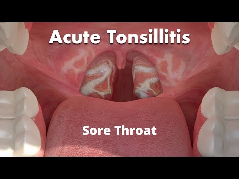 Video: Tonsillitis Vs. Strep Grlo: U čemu Je Razlika?