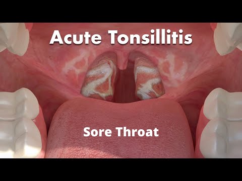 Sore throat: Do I need Antibiotics?