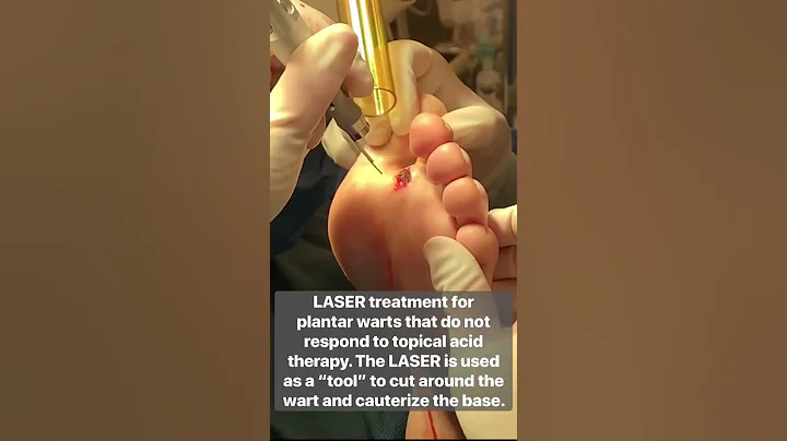 LASER TREATMENT FOR WARTS!INSANE! #shorts