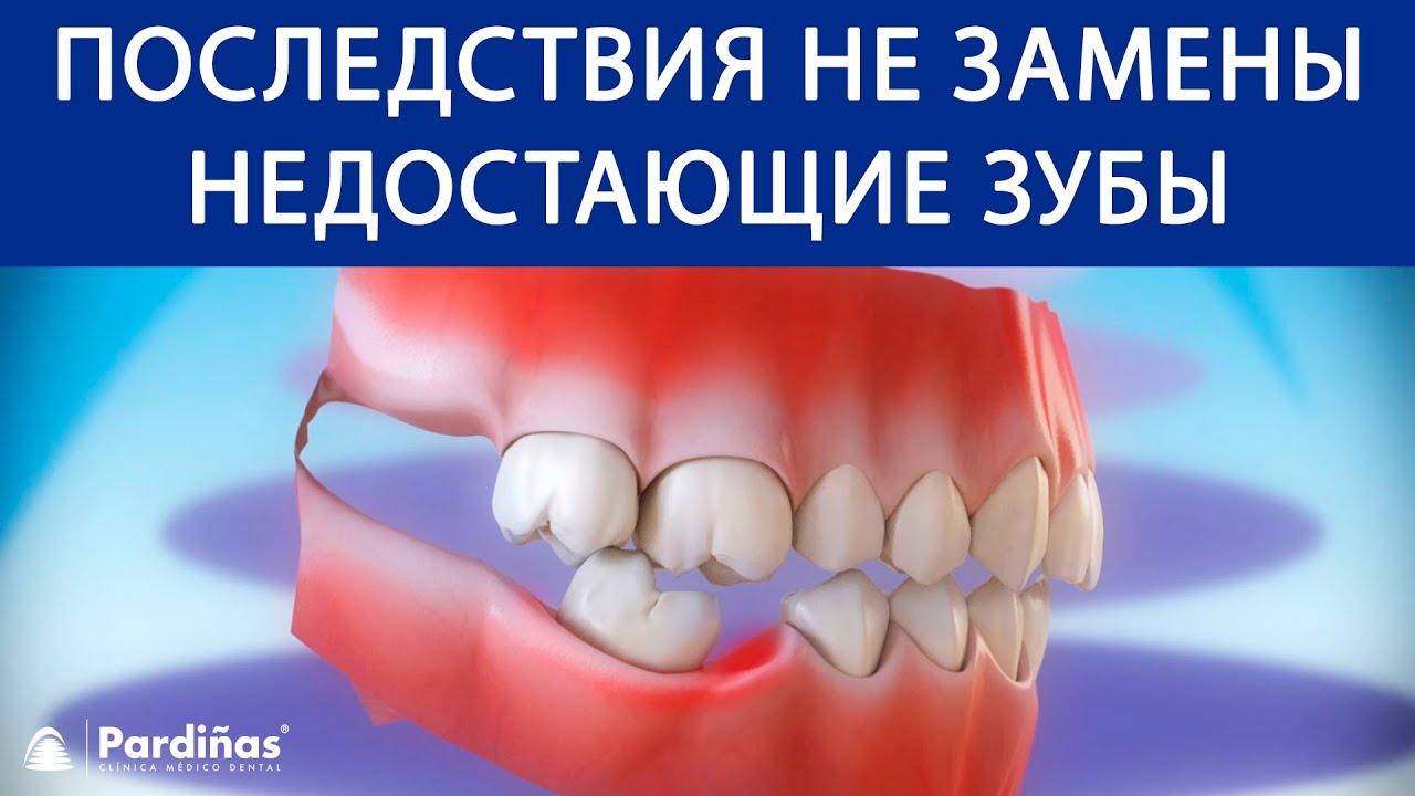 Последствия не замены недостающие зубы ©