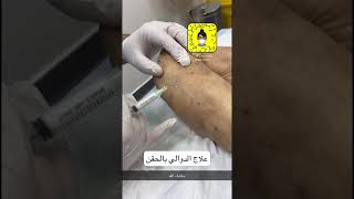 جلسة حقن  ل دوالي الساقين مباشرة   👨🏻‍⚕️💉 مع دكتور محمد الطواله