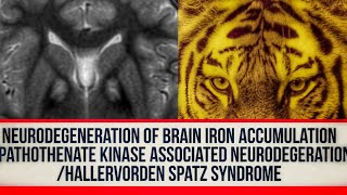 Neurodegeneration of brain iron accumulation/Hallervorden Spatz