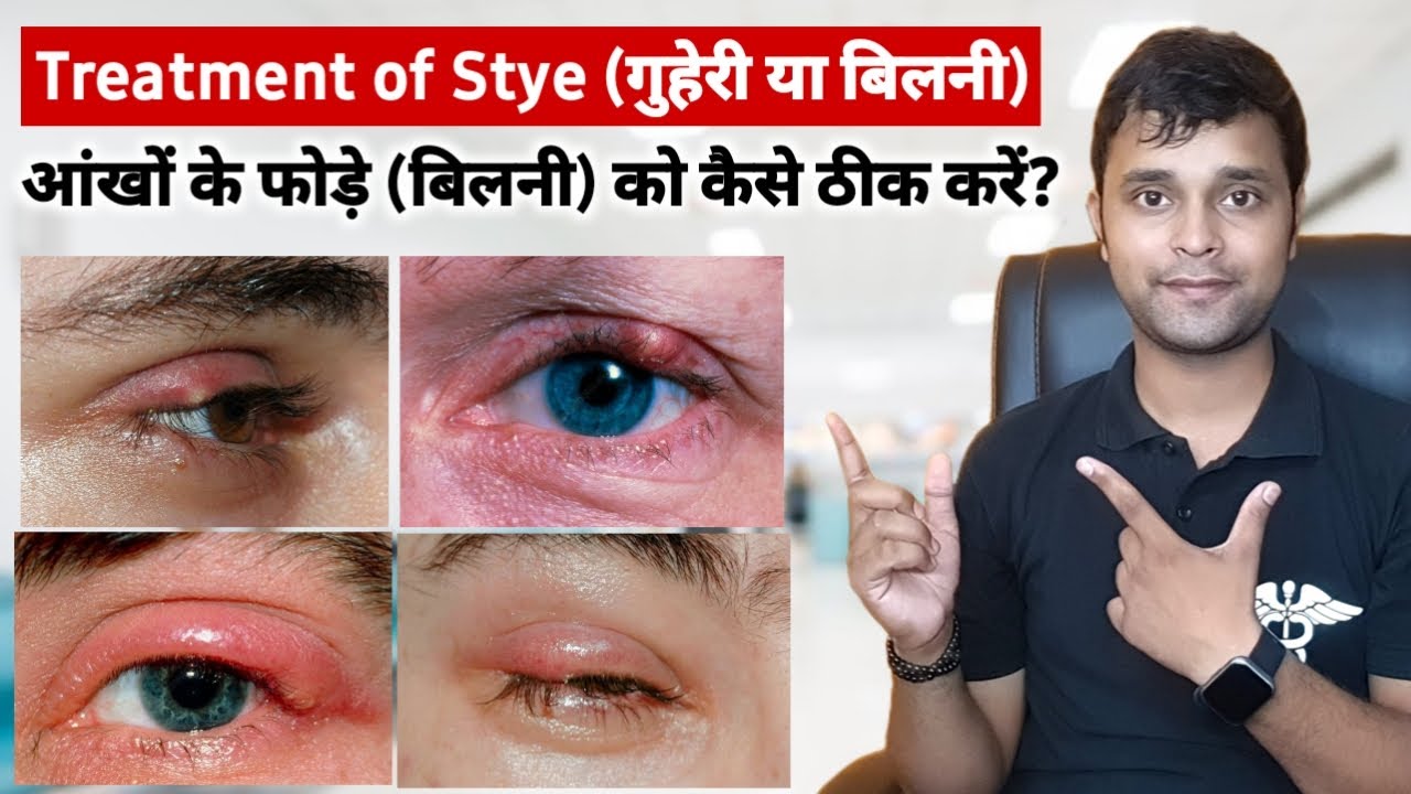 stye treatment in hindi बिलनी कैसे ठीक होगा Ciprofloxacin Eye drops
