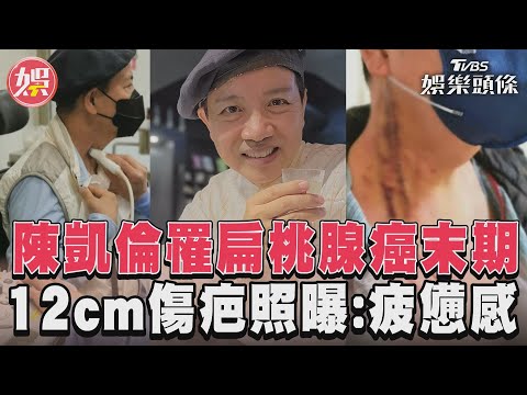 陳凱倫罹扁桃腺癌末期 12cm傷疤照曝：疲憊感│TVBS娛樂頭條
