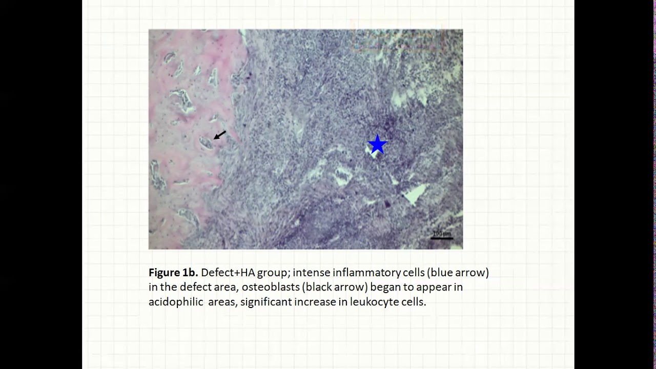 599 - Effects of Hyaluronic Acid on Alloplastic Bone Graft Applied Rat Calvarial Bone Defect Model
