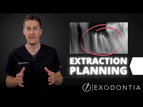 Vídeo: Les extraccions dentals són segures?