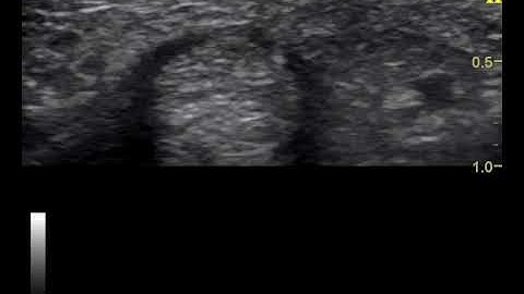 Ultrasound-guided trigger finger injection