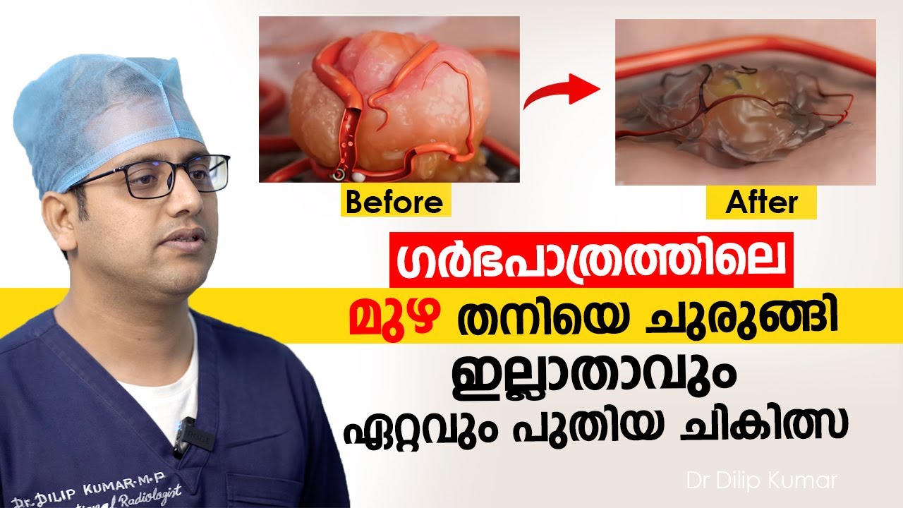 ഗർഭപാത്രത്തിലെ മുഴ തനിയെ ചുരുങ്ങി ഇല്ലാതാവും ഏറ്റവും പുതിയ ചികിത്സ | Fibroid Treatment Malayalam