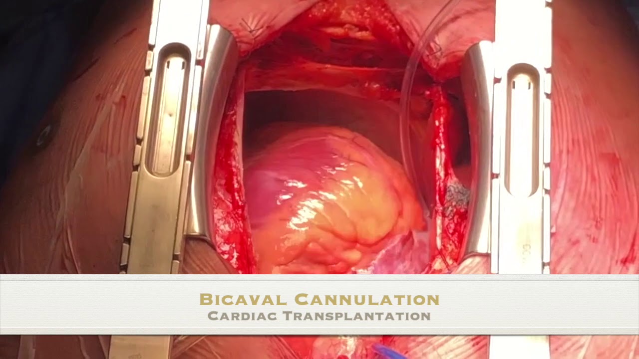 Heart Transplantation in Argentina: Tips and Tricks After 200 Cases Heart Transplantation in Argentina: Tips and Tricks After 200 Cases
