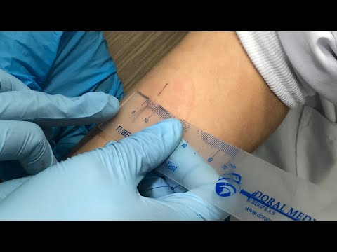 Video: ¿Cuándo se realiza la prueba cutánea de la tuberculina?