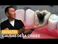 ¡Te cepillas los dientes correctamente y aún así tienes caries! Aquí está el POR QUÉ