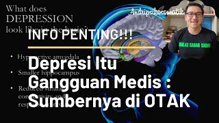 Penting Diketahui!!! Depresi Itu Gangguan Medis : Sumbernya Ada di Otak