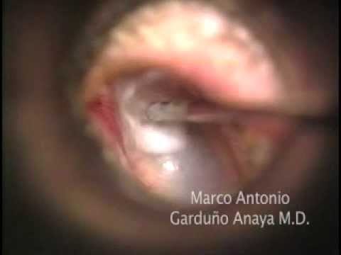 This video shows you intratympanic drug delivery to the inner ear. Our protocol takes place in the outpatient clinic under mi-croscopic control. The patient lies flat on a stretcher in the office with the neck fully extended and the head turned 45 degrees to the opposite side. We use Emla cream (Lidocaine 2.5%/Prilocaine 2.5%, Astra Zeneca Pharmaceuticals, LP, Wilmington, DE) to regionally anesthetize the tympanic membrane in the quadrant anterosuperior of the involved ear. Either the dexamethasone solution, gentamicine or hydrogel are loaded into a 3-mL syringe on which is placed a 22-gauge needle. The tip of the needle is angled. Filling the middle ear with a simple needle injection was not difficult. After the injection was administered slowly, the patient was instructed to lie in the supine position with the treated ear up for one hour, to keep their head still, and to swallow as little as possible, with no talking. Subsequent injections were delivered in the same way each day for the next 4 days. After each day's procedure the patient returned to his or her normal daily activities.