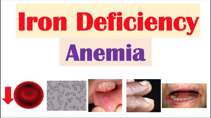 Nursing Paper Example on Iron-Deficiency Anemia [SOLVED]
