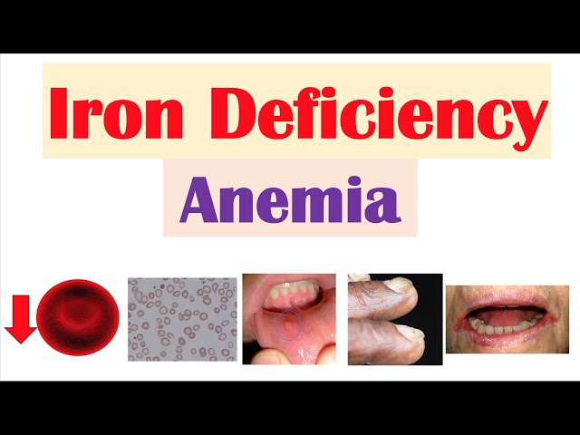 iron deficiency anemia slide