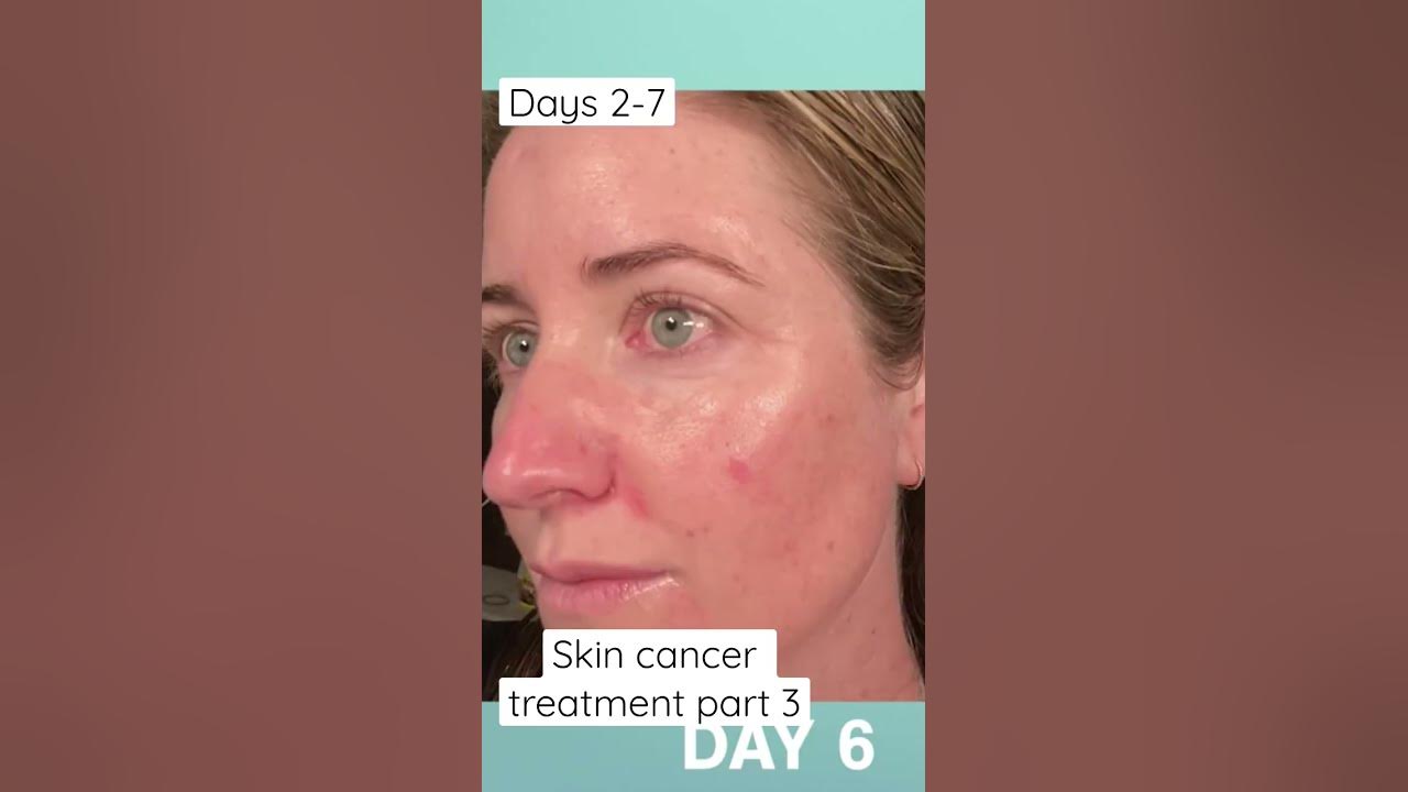 Days 2 7 of fluorouracil treatment for skin cancer youtube