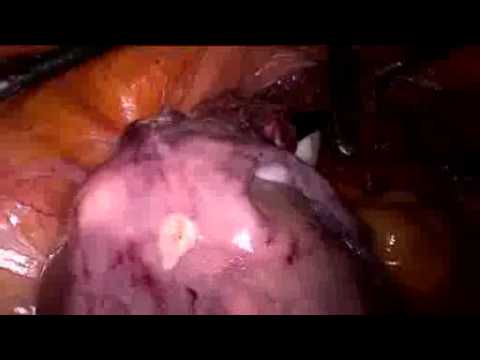 Video: Fibroma Dell'utero, Fibroma Della Vagina