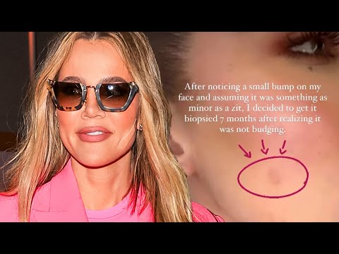 Khloé Kardashian Reveals HEALTH SCARE and Explains Mysterious Face Bandage