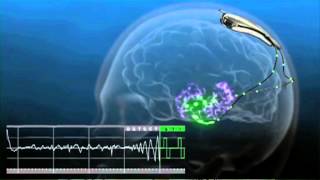 An Implant to Prevent Seizures