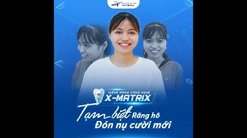 KHẮC PHỤC HOÀN TOÀN RĂNG HÔ BẰNG CÔNG NGHỆ X- MATRIX