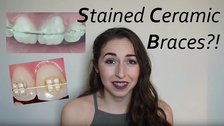 Do ceramic braces turn yellow? (2023)