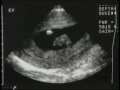 Sonography of first Trimester Pregnancy