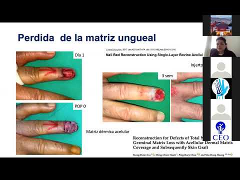 Vídeo: La Exposición Al Alcohol Disminuye La Expresión De Osteopontina Durante La Curación De Fracturas Y La Migración De Células Madre Mesenquimales Mediadas Por Osteopontina In Vitro