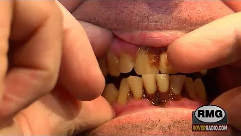Jeffrey's teeth are rotting out