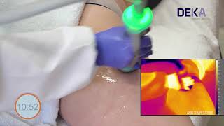 DEKA Tutorial ONDA Trattamento Cellulite