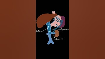 Distal splenorenal shunt #Medicine #generalsurgery #clearmed