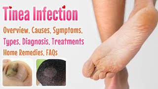 Tinea overview, causes, sign and symptoms, diagnosis, treatment, home remedies and FAQs