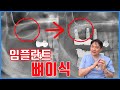 [옥수수치과TV] 임플란트 뼈이식이 궁금해요!?