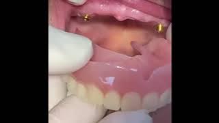 Snap in Dentures