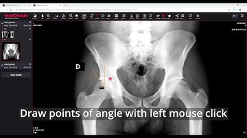 MedDream DICOM Viewer: measure the angle