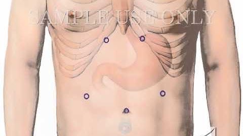 GERD (Reflux Disease) Surgery - Nissen Fundoplication