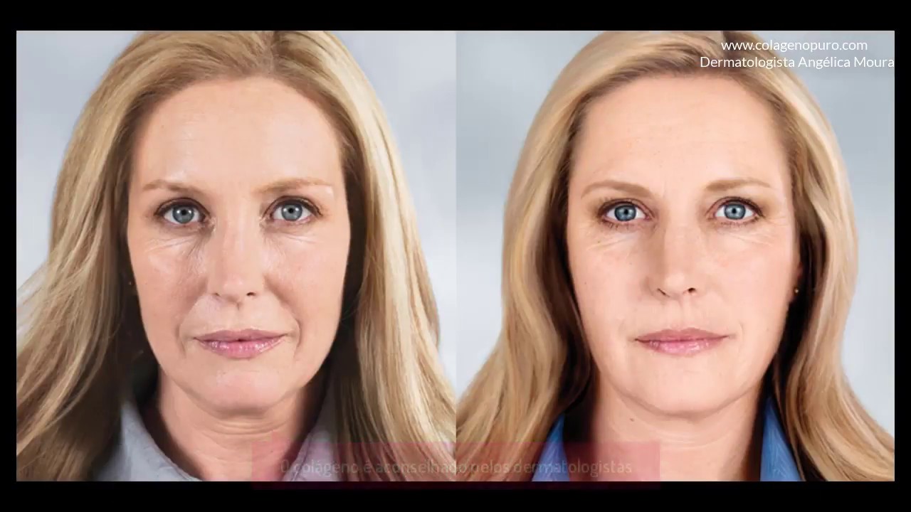 Colágeno en la Cara Inyectado: Rejuvenecimiento y Resultados Visibles