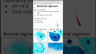 Bacterial vaginosis