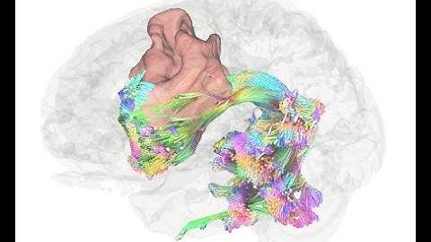Quick 3D manual segmentation of a brain tumor from T2 FLAIR image on DSI Studio