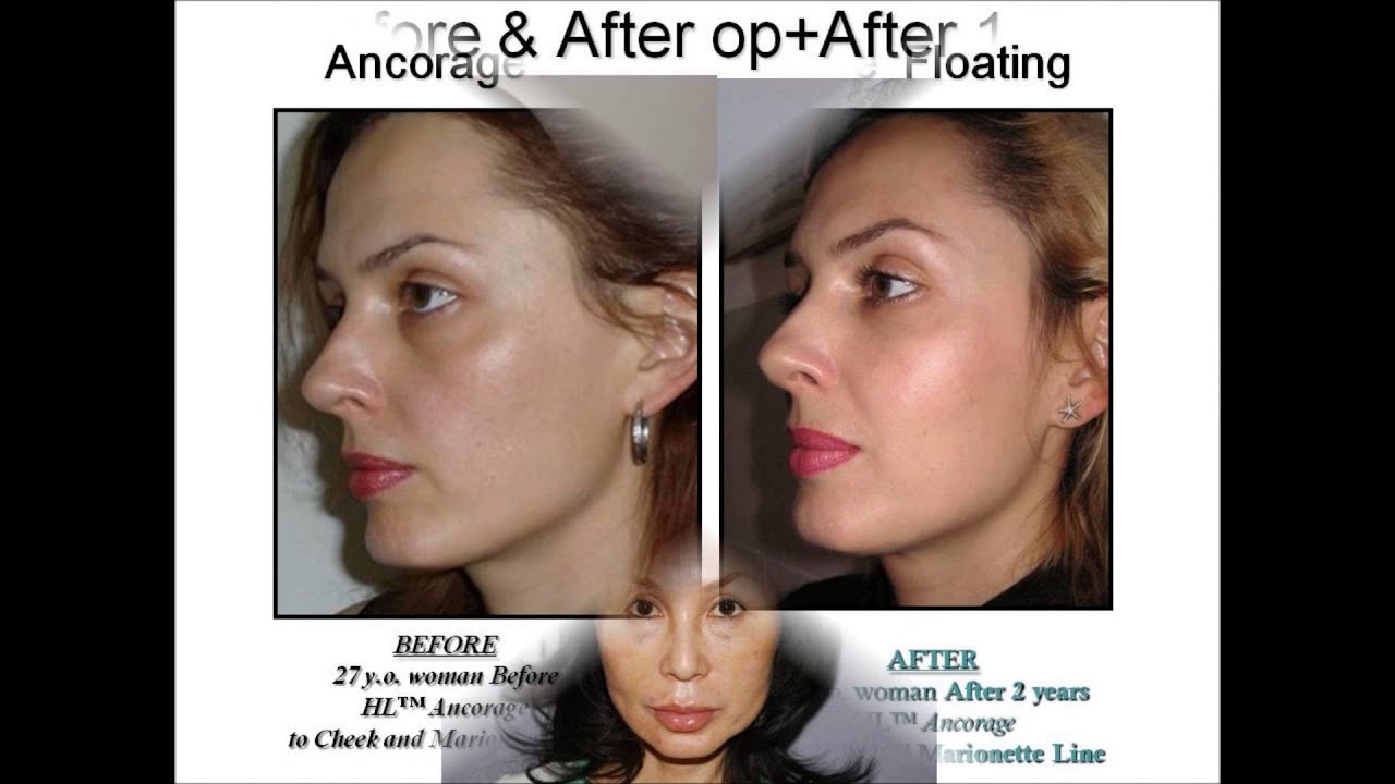 Astarte Absorbable threadlifts Mini Facelifts and Necklifts - YouTube