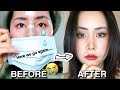 Something BAD Happened To My Nose... | Rhinoplasty Revision Story