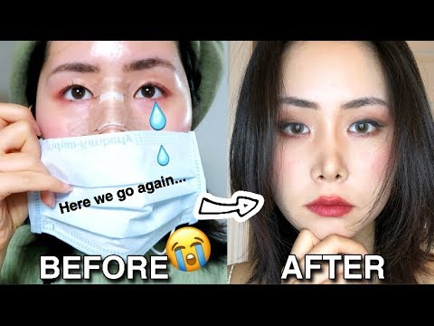 Something Bad Happened To My Nose Rhinoplasty Revision Story Youtube Something Bad Happened To My Nose Rhinoplasty Revision Story Youtube