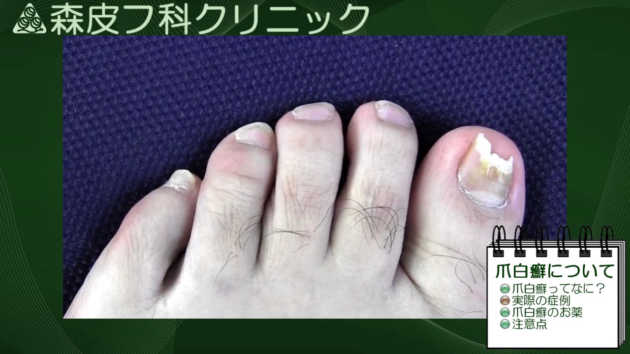 動画による皮膚病の解説 第５回 爪白癬 Youtube