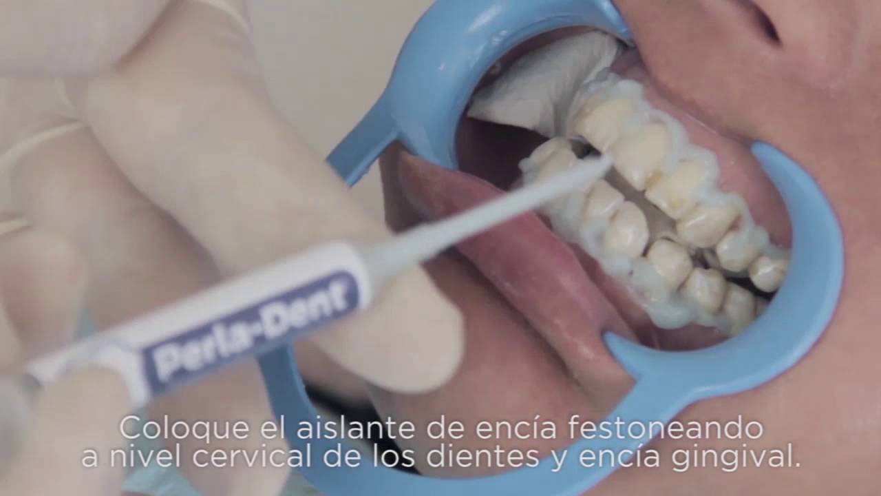 PerlaDent. Producto para Microabrasión. YouTube