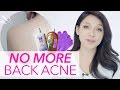 Get Rid of Back Acne/Pimple (in ONE WEEK)| GDiipa