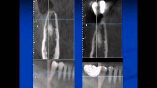 Radiographic Guide and Dual Scan