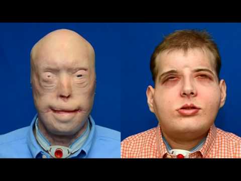 აშშ-ში სახის კანის სრული გადანერგვის ოპერაცია ჩატარდა