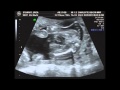 Live Ultrasound at 18 weeks 3 days pregnant with baby number two.