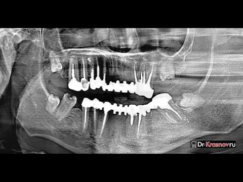 Видео: Колко оценки има в Швеция?