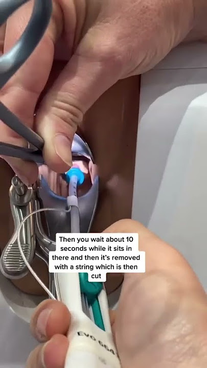 This is how an IUD is inserted